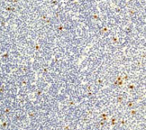 Ab32107, at a 1/50 dilution, staining Histone H3 in paraffin embedded lymphoma tissue by Immunohistochemistry. 