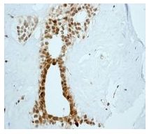 ab108525 at 1/100 dilution staining MAD3 in paraffin-embedded Human breast tissue by Immunohistochemistry (Formalin/PFA-fixed paraffin-embedded sections).