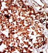 ab37619 at 1/50 staining Human cancer tissue (hepatocarcinoma) by IHC-P