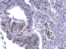 Immunohistochemical analysis of paraffin-embedded Human gastric carcinoma tissue labeling Histone H3 (phospho S28) with ab183767 at 1/500 dilution.