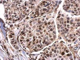 Immunohistochemical analysis of paraffin-embedded Human breast carcinoma tissue labeling Histone H3 (phospho S28) with ab183767 at 1/500 dilution.