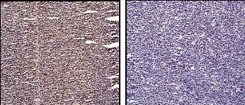 Immunohistochemical analysis of Histone H3 (phospho S28) expression in paraffin embedded lymphoma tissue sections, using 1/100 ab32388. left: untreated sample; right: phosphatase treated sample (negative control).Immunohistochemical analysis of Histone H3 (phospho S28) expression in paraffin embedded lymphoma tissue sections, using 1/100 ab32388. left: untreated sample; right: phosphatase treated sample (negative control).