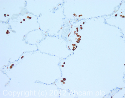 IHC image of Mannose Receptor staining in human lung formalin fixed paraffin embedded tissue section, performed on a Leica BondTM system using the standard protocol F. The section was pre-treated using heat mediated antigen retrieval with sodium citrate buffer (pH6, epitope retrieval solution 1) for 20 mins. The section was then incubated with ab64693, 0.1µg/ml, for 15 mins at room temperature and detected using an HRP conjugated compact polymer system. DAB was used as the chromogen. The section was then counterstained with haematoxylin and mounted with DPX. For other IHC staining systems (automated and non-automated) customers should optimize variable parameters such as antigen retrieval conditions, primary antibody concentration and antibody incubation times.