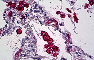 ab117644, at 5 µg/ml, staining Mannose Receptor in Formalin-fixed, Paraffin-embedded Human Lung (Macrophages) tissue by Immunohistochemistry.