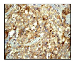 Immunohistochemical staining of MAP1LC3A in paraffin embedded human breast carcinoma using ab52768 at a 1/100 dilution.Immunohistochemical staining of MAP1LC3A in paraffin embedded human breast carcinoma using ab52768 at a 1/100 dilution.