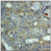 Ab53277 (1:50) staining human MAPK6 in human breast carcinoma tissue by immunohistochemistry using paraffin embedded tissue.Ab53277 (1:50) staining human MAPK6 in human breast carcinoma tissue by immunohistochemistry using paraffin embedded tissue.