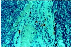 ab2377 - immunohistochemistry Formalin fixed paraffin embedded human tonsil stained with Mast Cell Chymase using ABC and AEC chromogen.