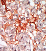 ab37824, at a 1/50 dilution, staining MATK in Human hepatocarcinoma by Immunohistochemistry, Formalin fixed and Paraffin embedded tissue. ab37284 was peroxidase-conjugated to the secondary antibody, followed by AEC staining. This data demonstrates the use of this antibody for immunohistochemistry; clinical relevance has not been evaluated.
