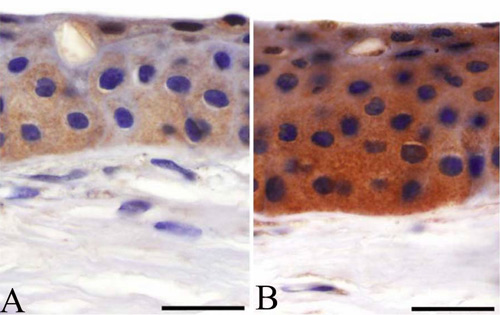 Immunohistochemical analysis of Human cornea tissue, staining Matrilin 4 wih ab106379. Tissue was taken from healthy patients (left) or patients with granular dystrophy (right). Sections were blocked with blocking solution for 30 minutes at room temperature before incubation with primary antibody (1/300) overnight at 4°C. Staining was detected with DAB.