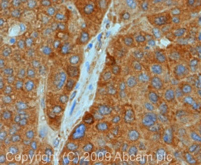 IHC image of MAVS staining in human liver carcinoma FFPE section, performed on a Leica BondTM system using the standard protocol F. The section was pre-treated using heat mediated antigen retrieval with sodium citrate buffer (pH6, epitope retrieval solution 1) for 20 mins. The section was then incubated with ab25084, 1µg/ml, for 15 mins at room temperature and detected using an HRP conjugated compact polymer system. DAB was used as the chromogen. The section was then counterstained with haematoxylin and mounted with DPX.
