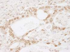 ab84753 at 1/250 dilution staining MBD2 in human stomach carcinoma by Immunohistochemistry, Formalin-fixed, Paraffin-embedded tissue. Detection: DAB staining.