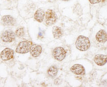 ab84753 at 1/250 dilution staining MBD2 in human testicular seminoma by Immunohistochemistry, Formalin-fixed, Paraffin-embedded tissue. Detection: DAB staining.