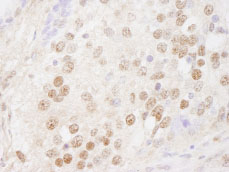 ab84753 at 1/250 dilution staining MBD2 in mouse teratoma by Immunohistochemistry, Formalin-fixed, Paraffin-embedded tissue. Detection: DAB staining.