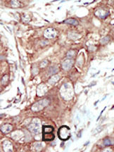 ab5508 staining MCK10 in human breast carcinoma (BC) tissue by Immunohistochemistry (Formalin/PFA-fixed paraffin-embedded sections).