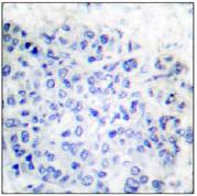 ab53709, at a 1/50 dilution, plus immunising peptide, staining Human MCL1 in Breast Carcinoma, using Immunohistochemistry, Paraffin embedded tissue.