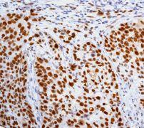 ab76023, at a 1/100 dilution, staining MCM5 in paraffin embedded human squamous cell cervical carcinoma tissue. A HRP/AP polymerized secondary antibody was used.