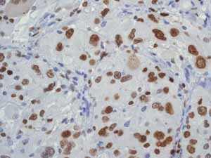 ab76023 showing positive staining in Glioma tissue.