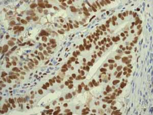 ab76023 showing positive staining in Colonic adenocarcinoma tissue.