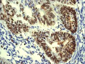 ab76023 showing positive staining in Endometrial carcinoma tissue.