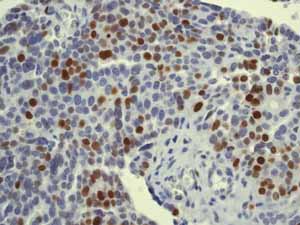 ab76023 showing positive staining in Ovarian carcinoma tissue.