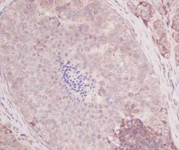 ab9669 at 2.5 µg/ml staining human breast invasive ductal carcinoma tissue by IHC-P.  The anitbody was incubated for two hours at room temperature. An HRP-labeled polymer detection system was used with a DAB chromogen. Heat induced antigen retrieval with a pH 6.0 Sodium Citrate buffer is recommended. 