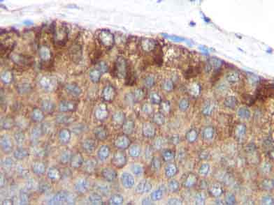 ab9858 staining MCP1 in human breast invasive ductal carcinoma tissue section by Immunohistochemistry (Formalin/PFA fixed paraffin-embedded sections). Tissue underwent heat mediated antigen retrieval in sodium citrate buffer (pH 6.0). The primary antibody was used at 10 ug/ml and incubated with sample at 4°C overnight. A HRP-labeled polymer detection system was used with a DAB chromogen.
