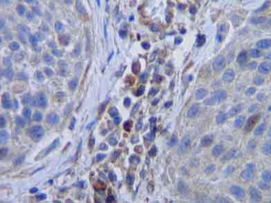 ab9693 staining MCSF in human cervical squamous cell carcinoma section by Immunohistochemistry (Formalin/PFA fixed paraffin-embedded sections). Tissue underwent heat mediated antigen retrieval in sodium citrate buffer (pH 6.0). The primary antibody was used at 5 ug/ml and incubated with sample at 4°C overnight. A HRP-labeled polymer detection system was used with a DAB chromogen.
