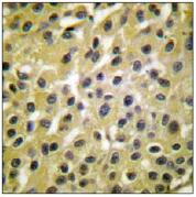 ab53710, at a 1/50 dilution, minus immunising peptide, staining Human MDM2 in Breast Carcinoma, using Immunohistochemistry, Paraffin embedded tissue.