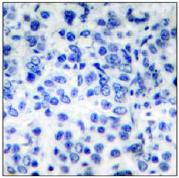 ab53710, at a 1/50 dilution, plus immunising peptide, staining Human MDM2 in Breast Carcinoma, using Immunohistochemistry, Paraffin embedded tissue.
