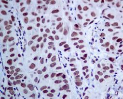 ab129170, at 1/100 dilution staining MED4 in paraffin-embedded Human breast carcinoma tissue, by Immunohistochemistry.