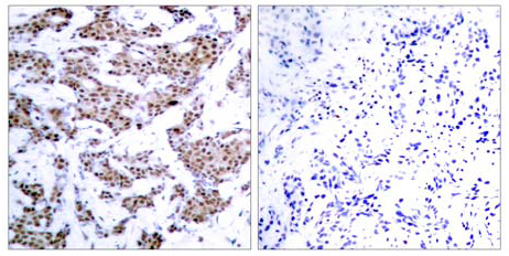 Immunohistochemical analysis of paraffin-embedded breast carcinoma. Left: using ab30644 (10ug/ml); right: the same antibody preincubated with synthesized phosphopeptide.