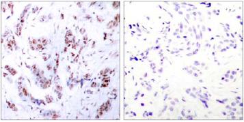 Ab30668, at a dilution of 1/50, staining MEF2A (phospho T312) in paraffin embedded breast carcinoma tissue by Immunohistochemistry. Left image: Untreated. Right image: The same antibody preincubated with immunizing peptide.