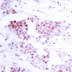 ab39420, at a 1/100 dilution, staining human MEF2A in breast carcinoma tissue by Immunohistochemistry, Paraffin embedded tissue.