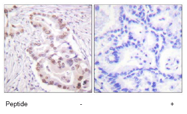 ab61252 at 1/50 - 1/100 dilution staining Histone H3 in human lung carcinoma by Immunohistochemistry, Paraffin-embedded tissue, in the absence or presence of the immunising peptide.