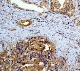 Immunohistochemical analysis of paraffin embedded prostate carcinoma using ab32517 at a dilution of 1/250.