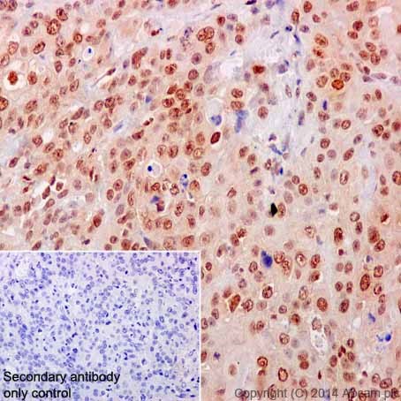 Immunohistochemical analysis of paraffin-embedded Human cervix carcinoma tissue labeling MEK3 + MEK6 with ab200831 at 1/250 dilution followed by Goat Anti-Rabbit IgG H&L (HRP) (ab97051) at 1/500 dilution. Nuclear and cytoplasmic staining on Human cervix carcinoma tissue is observed. Counter stained with Hematoxylin.Secondary antibody only control: Used PBS instead of primary antibody, secondary antibody is Goat Anti-Rabbit IgG H&L (HRP) (ab97051) at 1/500 dilution.