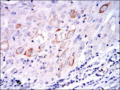 Immunohistochemical analysis of paraffin-embedded Human lung cancer tissues using ab119934 at a dilution of 1/200 with DAB staining.