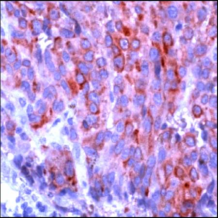 Human melanoma stained with anti-MelanA antibody, ab15468 by Immunohistochemistry (FFPE-sections).