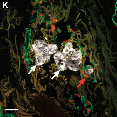 Immunohistochemical analysis of Human lymphatic vessels from melanoma patients, staining MelanA (white) with ab15468.