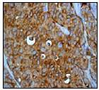 Ab51061 (1/100) staining human MelanA in melanoma tissue by immunohistochemistry using paraffin embedded tissue.Ab51061 (1/100) staining human MelanA in melanoma tissue by immunohistochemistry using paraffin embedded tissue.