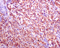 Immunohistochemical analysis of formalin-fixed, paraffin-embedded Human melanoma tissue labelling Melanoma gp100 with ab137078 at 1/100 dilution.