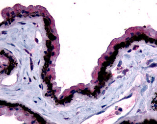 ab115336 at 10ug/ml staining Melatonin Receptor 1B in Formalin-fixed, Paraffin-embedded Human eye (retina) tissue by immunohistochemistry followed by biotinylated secondary antibody, alkaline phosphatase-streptavidin and chromogen.