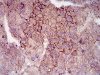 ab129373 at 1/200 dilution staining MELK in paraffin-embedded liver cancer tissue by immunohistochemistry, with DAB staining.