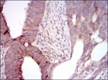ab129373 at 1/200 dilution staining MELK in paraffin-embedded liver cancer tissue by immunohistochemistry, with DAB staining.