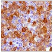 Immunohistochemistry (Formalin/PFA-fixed paraffin-embedded sections) analysis of human lymphoma tissue labelling MERTK with unpurified ab52968 at a 1/50 dilution.