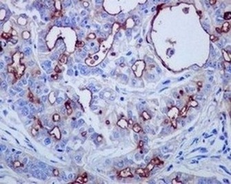 Immunohistochemical analysis of paraffin embedded Human mesothelioma tissue labelling Mesothelin with ab134109 at 1/1000.