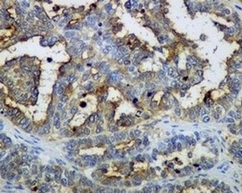 Immunohistochemical analysis of paraffin embedded Human ovarian carcinoma tissue labelling Mesothelin with ab134109 at 1/1000.