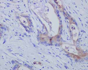 Immunohistochemical analysis of paraffin embedded Human Pancreatic carcinoma tissue using ab134109 showing +ve staining.