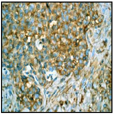 Ab51067 (1/100-1/250) staining human Met (c-Met) in human breast carcinoma tissue by immunohistochemistry using paraffin embedded tissue.Ab51067 (1/100-1/250) staining human Met (c-Met) in human breast carcinoma tissue by immunohistochemistry using paraffin embedded tissue.