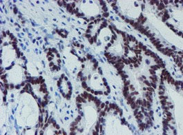 ab128528, at 1/150 dilution, staining METT10D in paraffin-embedded adenocarcinoma of Human colon tissue by Immunohistochemistry.